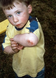 pediatric injuries